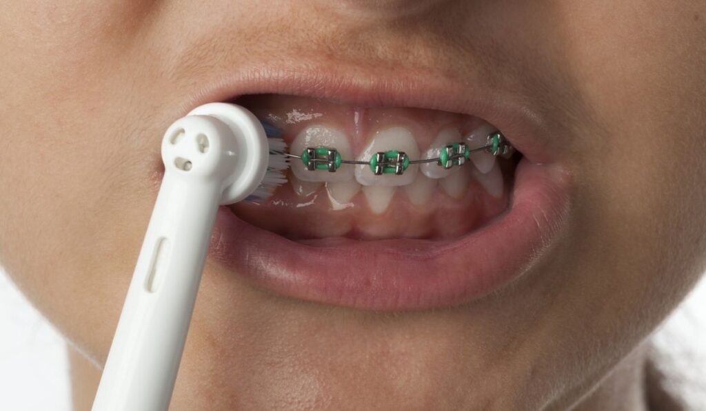Teenage girl is brushing her teeth with dental braces