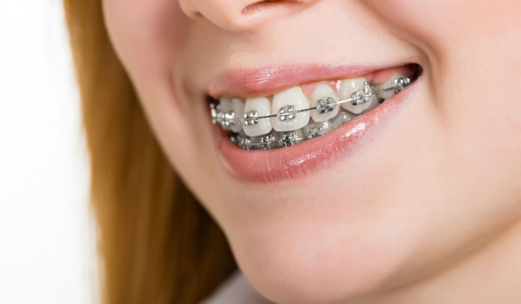 Beautiful young woman with brackets on teeth 