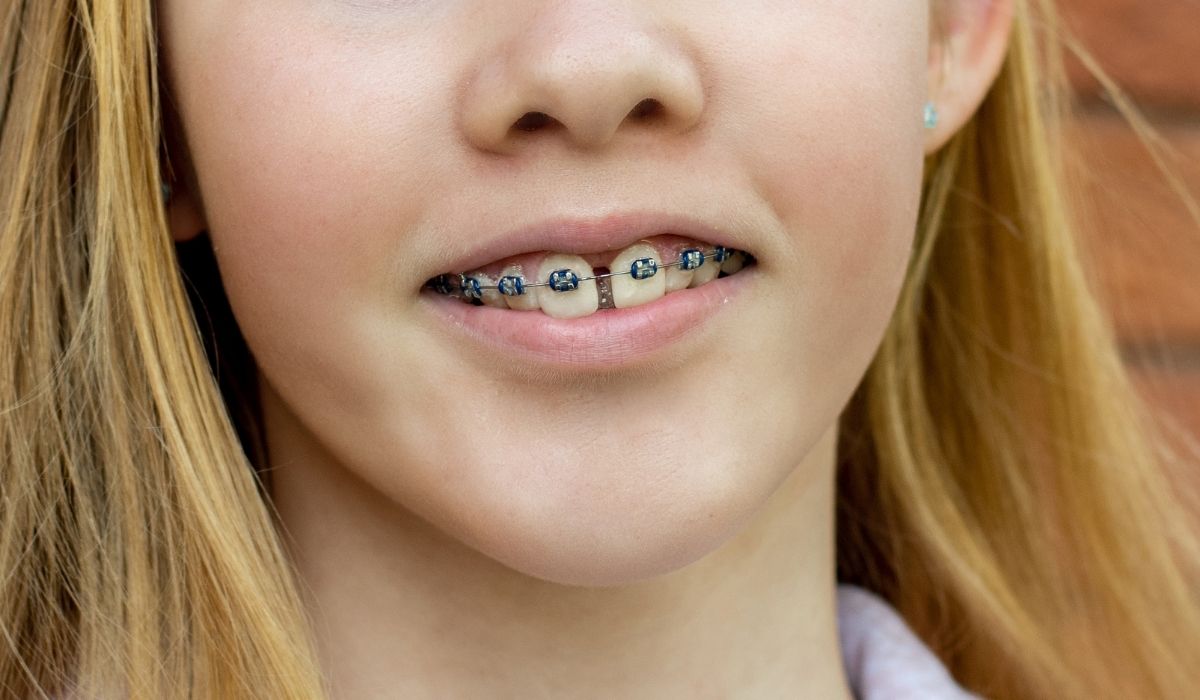 Close up of a teenage girl wearing metal braces