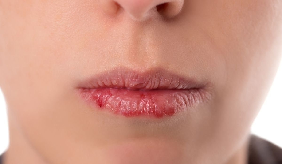 Closeup woman´s face with brittle and dry lips