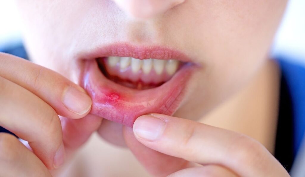Red and painful canker sore 