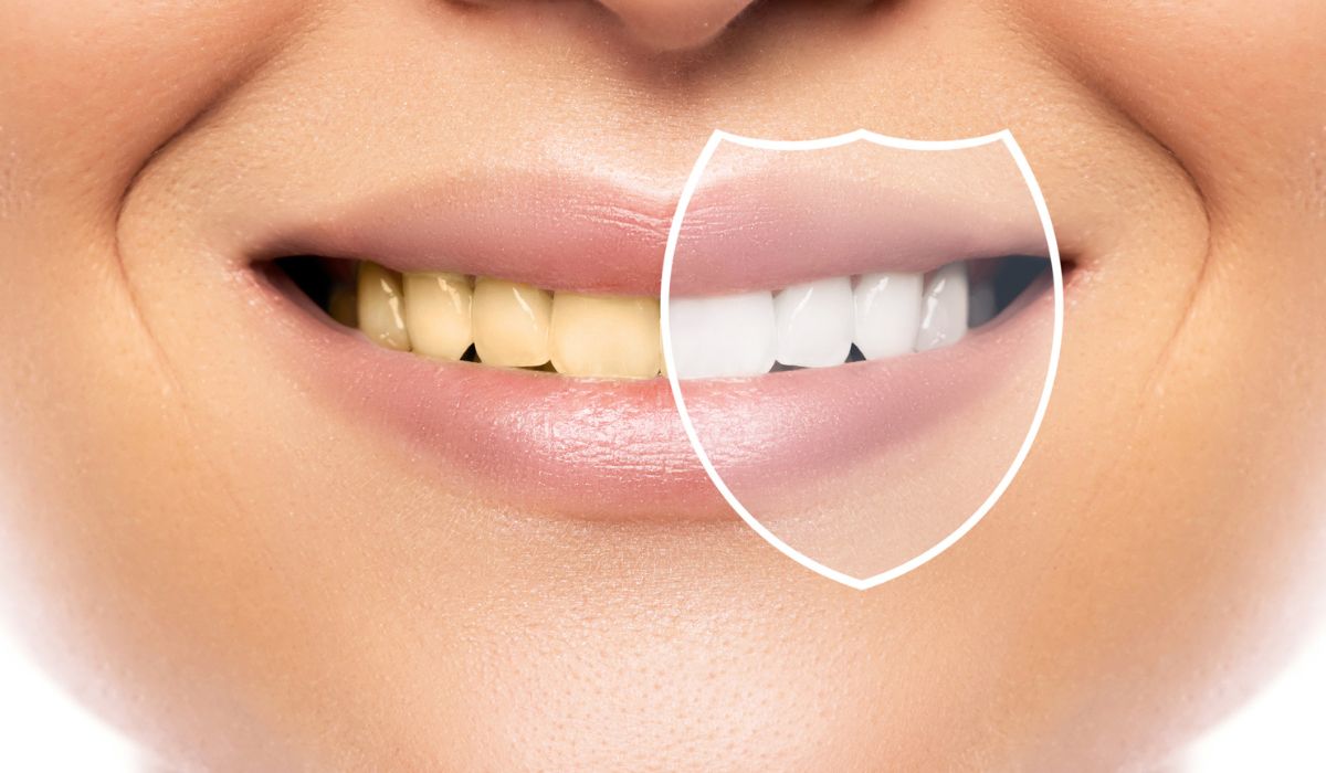 Teeth whitening and hygiene