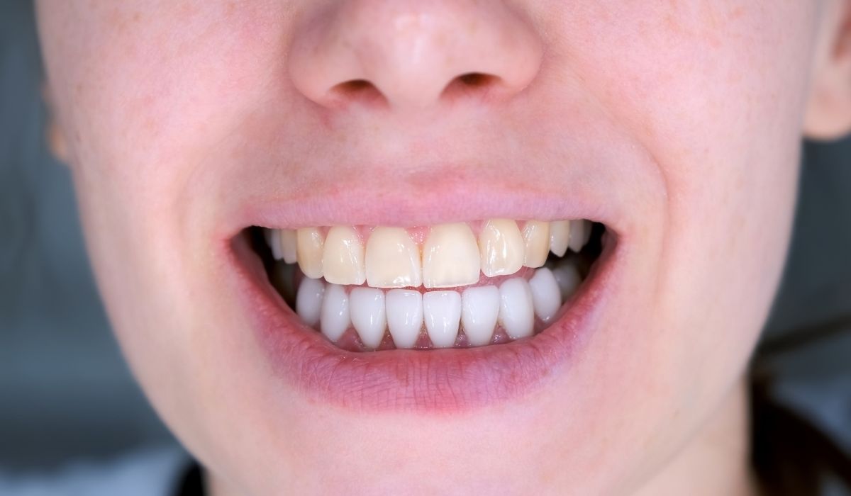 Teeth of woman with white veneers on lower and her yellow upper teeth