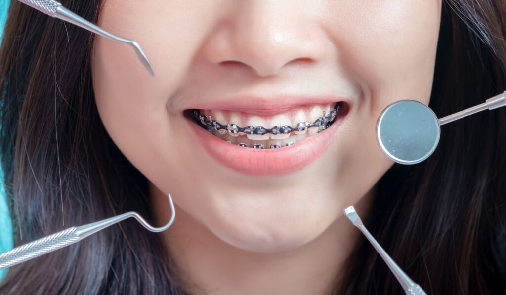 Close up Dental braces of woman wearing braces beauty smile with white teeth