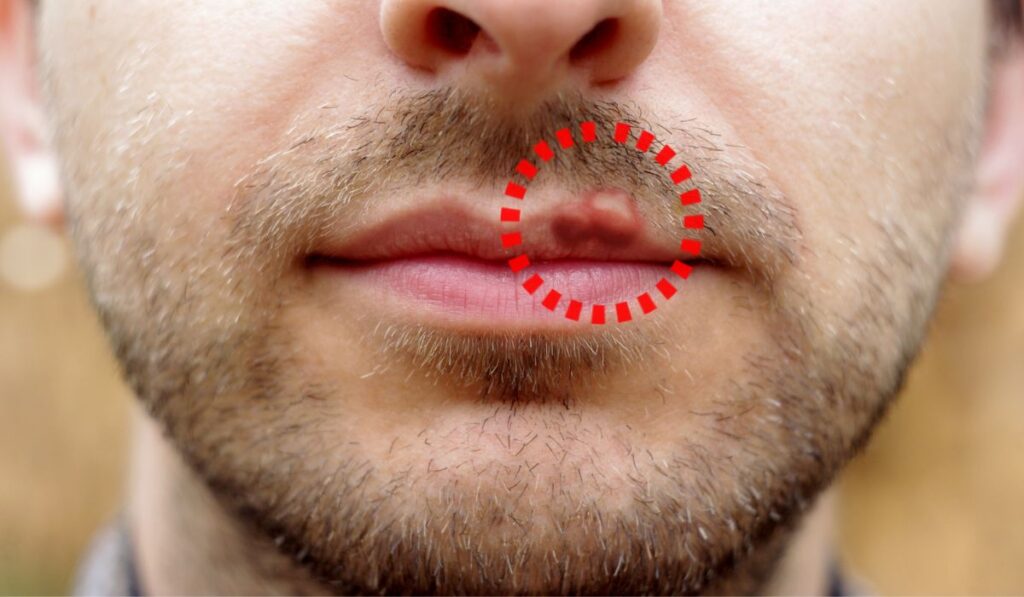 Closeup of a common cold sore virus herpes